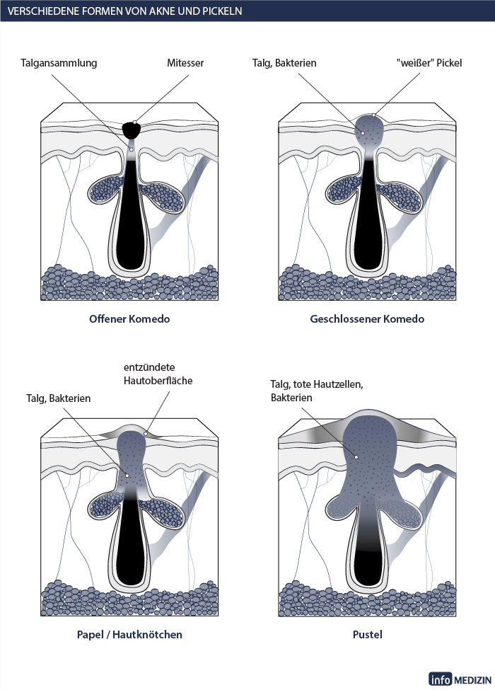 Akne - Formen, Ursachen, Diagnose ...