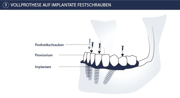 All-on-4 Schritt 3