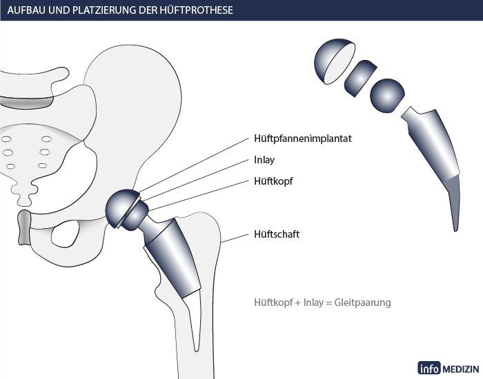 Aufbau einer Hüftprothese