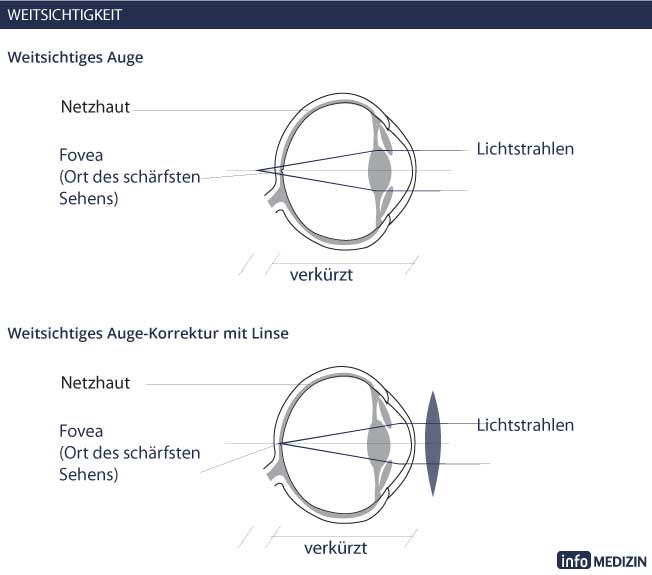 Sehrschwächen: Weitsichtigkeit Auge Korrektur