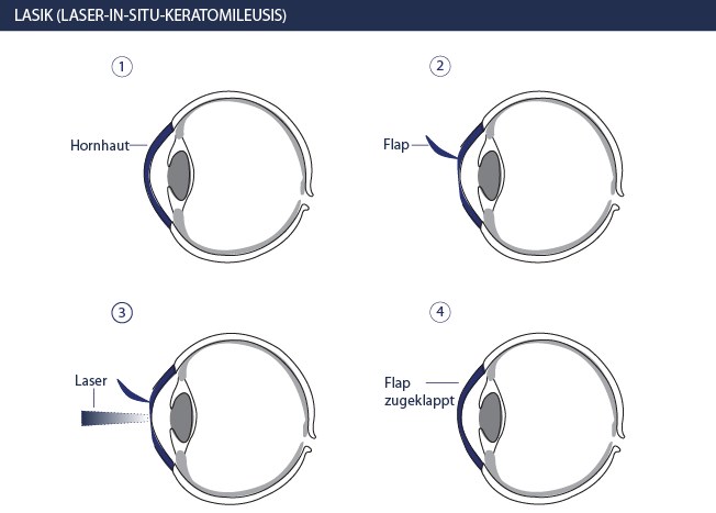 Augenlasern LASIK