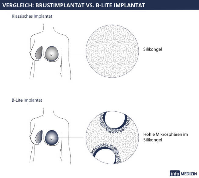 Illustration Querschnitt Brustimplantat B-Lite Vergleich. 