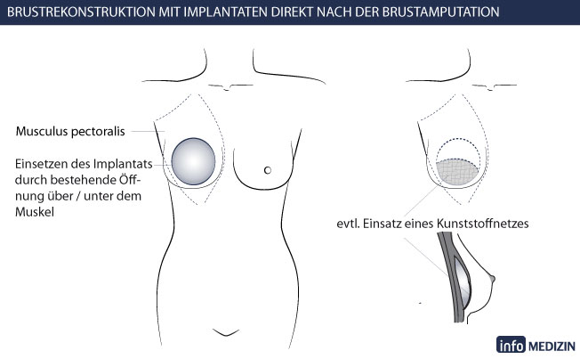 Brustrekonstruktion mit Implantaten