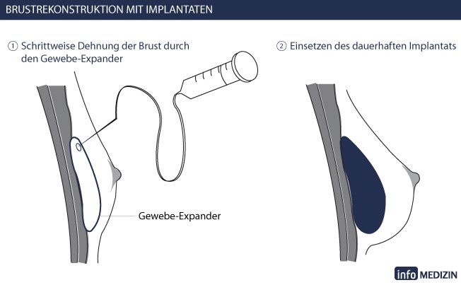 Brustrekonstruktion mit Implantaten Expander