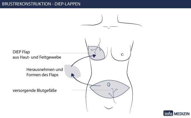 Brustrekonstruktion Eigengewebe Technik DIEP Lappen