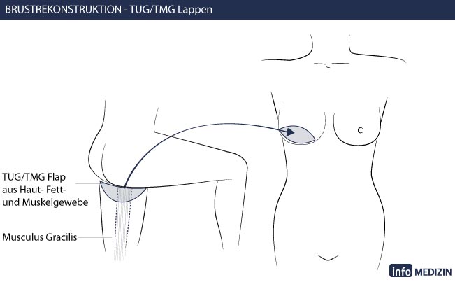 Brustrekonstruktion Eigengewebe Technik TUG TMG