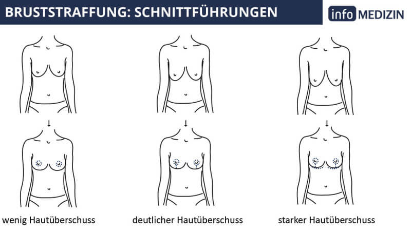 Bruststraffungstechniken