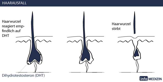 Haarausfall androgenetische Alopezie