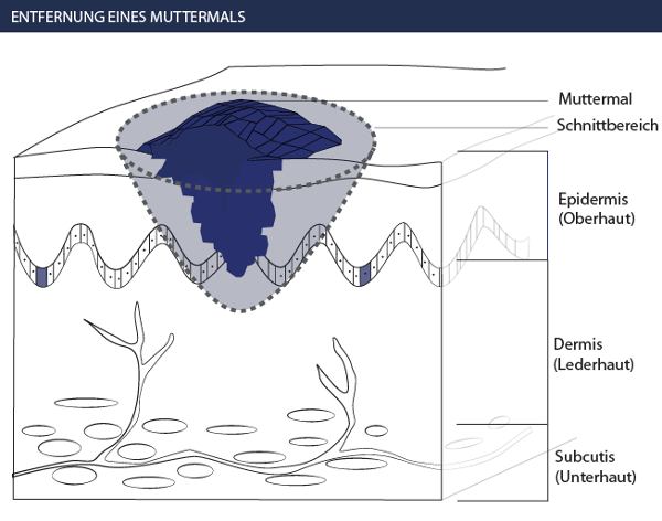 Muttermal entfernen