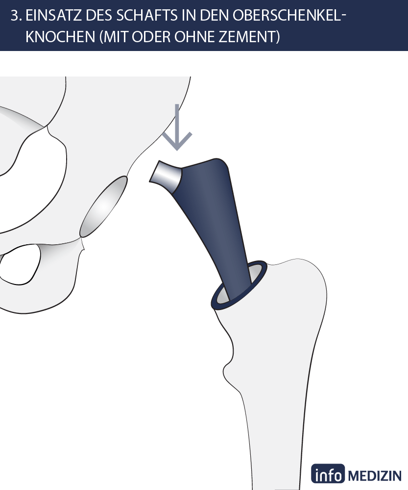 Hüft-OP Schritt 3