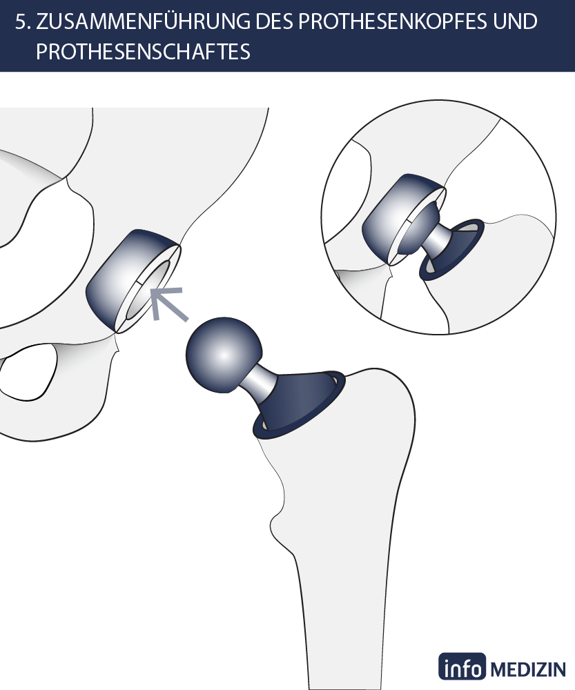 Hüft-OP Schritt 5