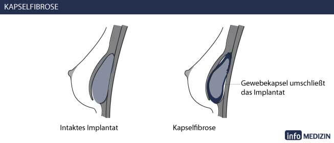 Kapselfibrose Querschnitt