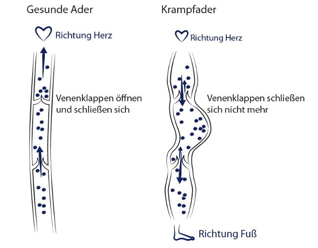 Krampfadern