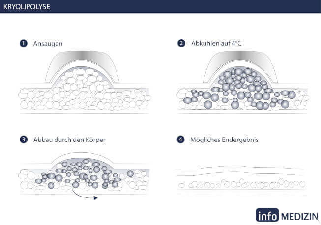 Ablauf Kryolipolyse