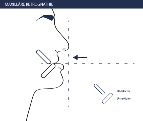 Maxilläre Retrognathie