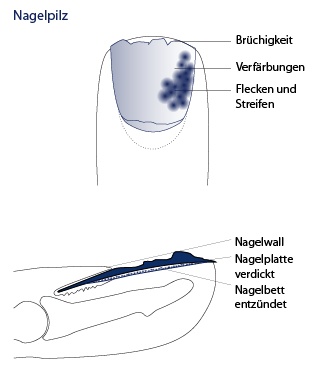 Fußnagel mit Nagelpilz