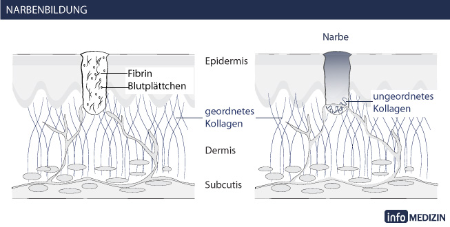 Schematische Darstellung wie Narben entstehen