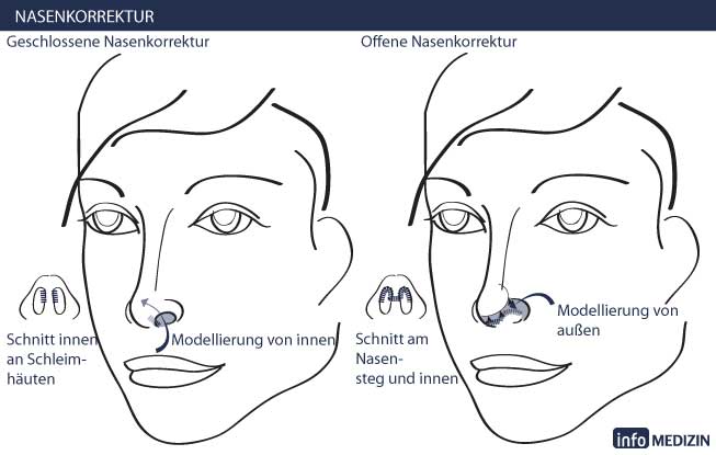 Nasenkorrektur - offen vs geschlossen