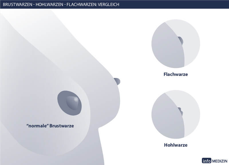 Schlupfwarzen Hohlwarzen Vergleich