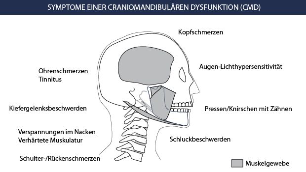 Symptome CMD Zähneknirschen