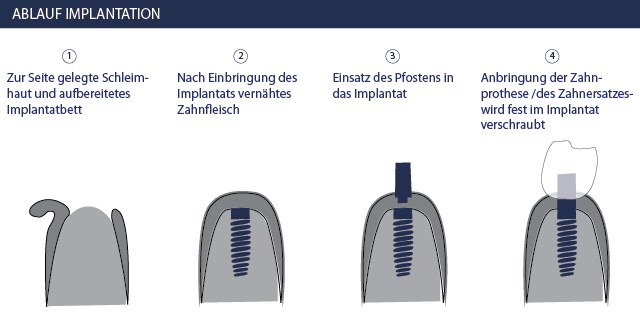 Zahnimplantate - Ablauf Implantation