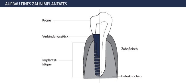 Zahnimplantate Aufbau Material