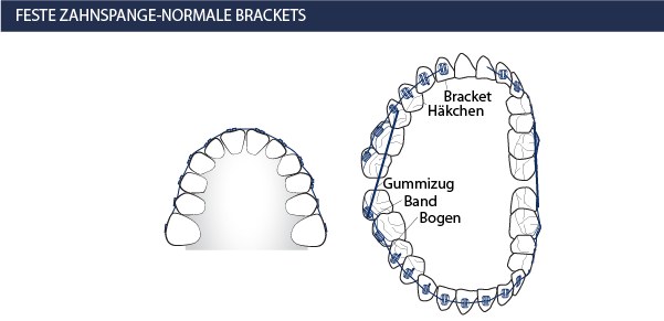 Feste Zahnspange Brackets