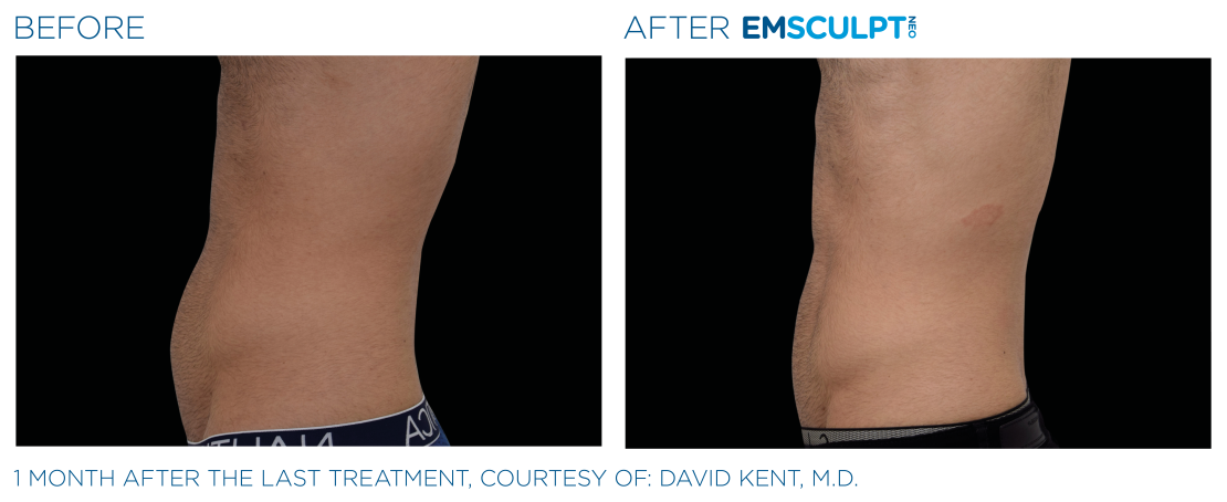 EMSCULPT® NEO Vorher Nachher Bauch