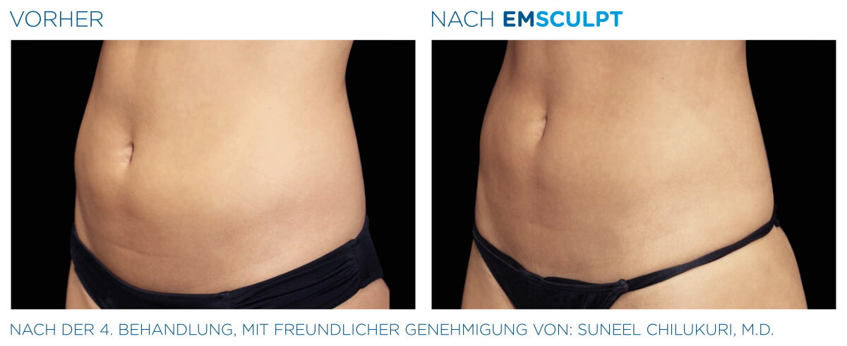 EMSCULPT® Körperstraffung Vorher Nachher