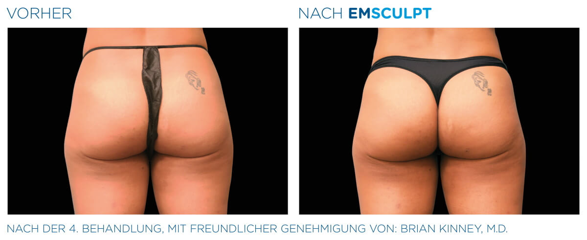 EMSCULPT® Körperstraffung Vorher Nachher