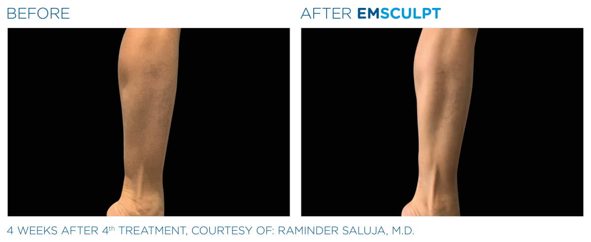 EMSCULPT® Körperstraffung Vorher Nachher