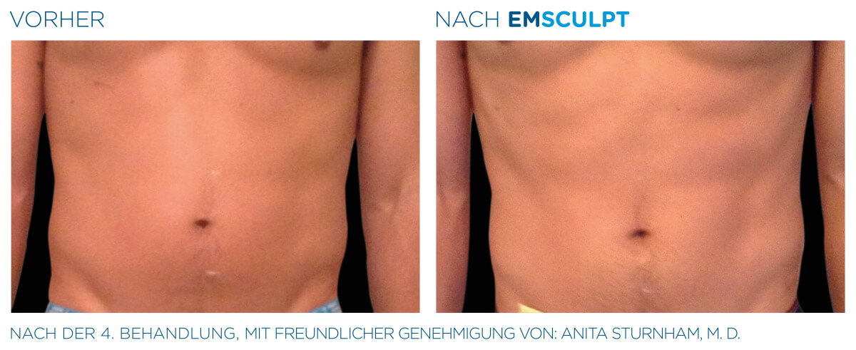 EMSCULPT® Körperstraffung Vorher Nachher