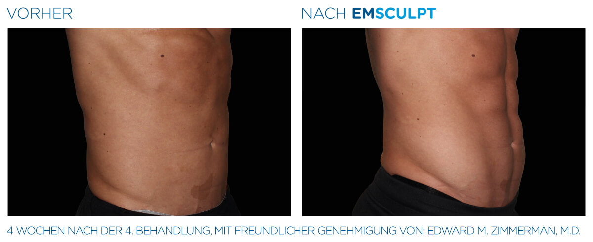 EMSCULPT® Körperstraffung Vorher Nachher