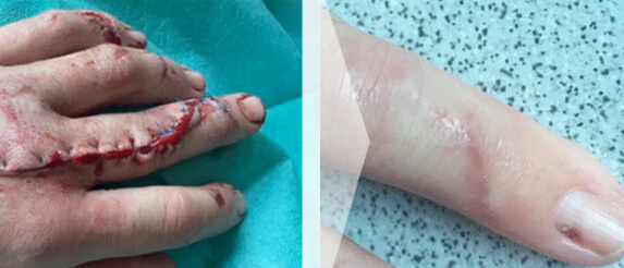 Vorher-Nacher-Bild Narbenbehandlung ScarCare Finger